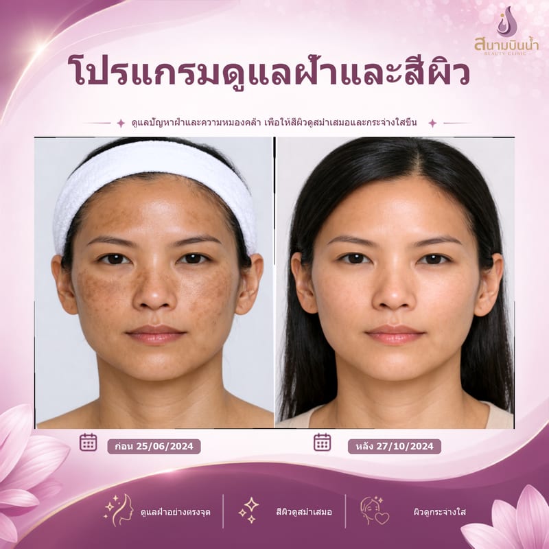 ภาพก่อน–หลัง รักษาฝ้า กรณีเฉพาะบุคคล