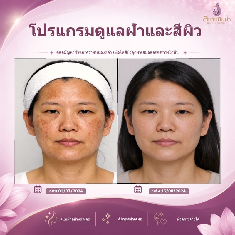 ภาพก่อน–หลัง รักษาฝ้า กรณีเฉพาะบุคคล