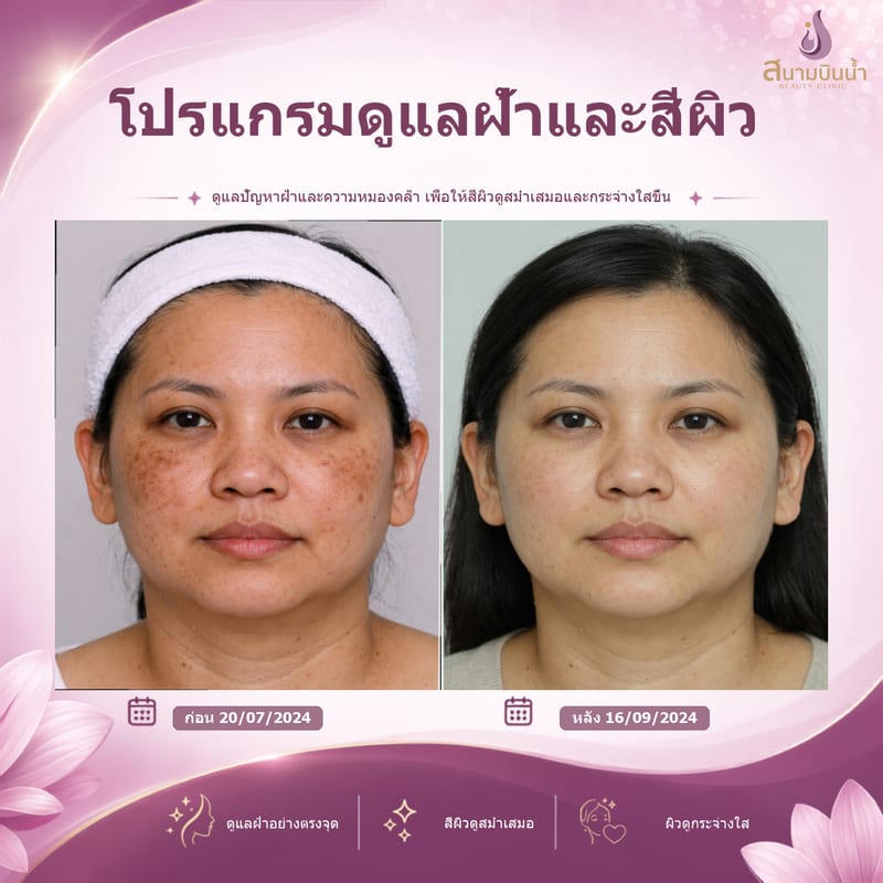 ภาพก่อน–หลัง รักษาฝ้า กรณีเฉพาะบุคคล