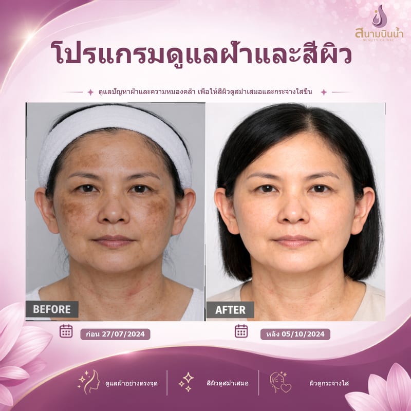 ภาพก่อน–หลัง รักษาฝ้า กรณีเฉพาะบุคคล