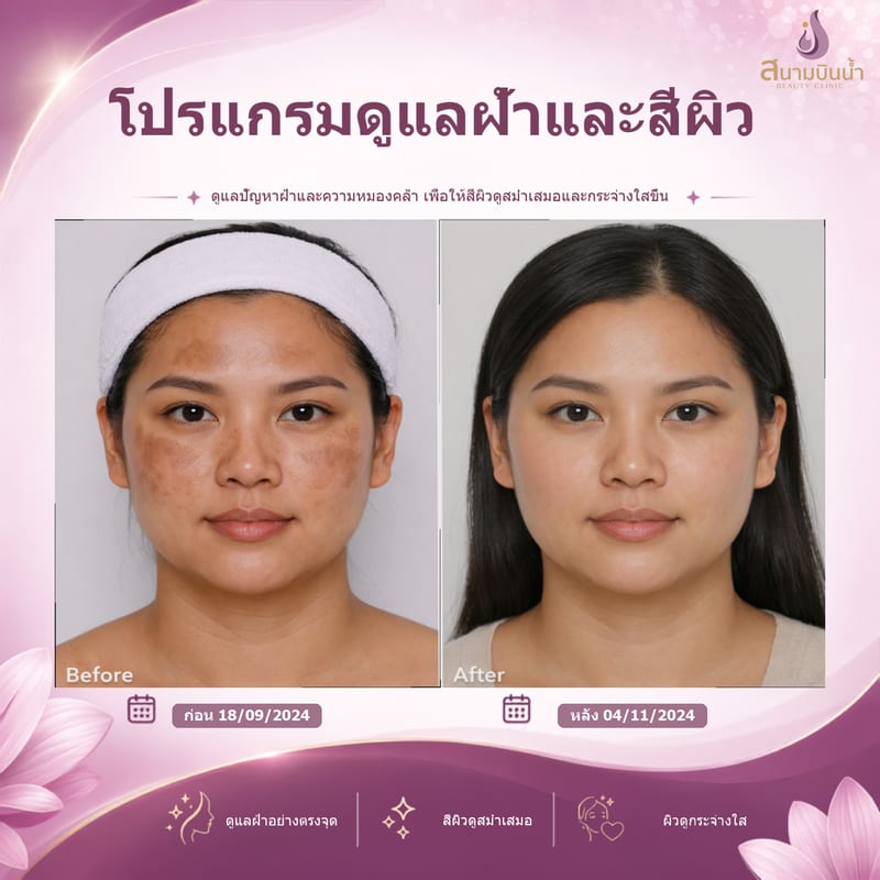 ภาพก่อน–หลัง รักษาฝ้า กรณีเฉพาะบุคคล