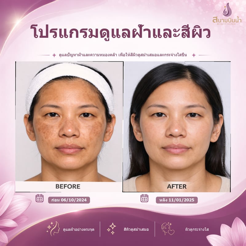 ภาพก่อน–หลัง รักษาฝ้า กรณีเฉพาะบุคคล
