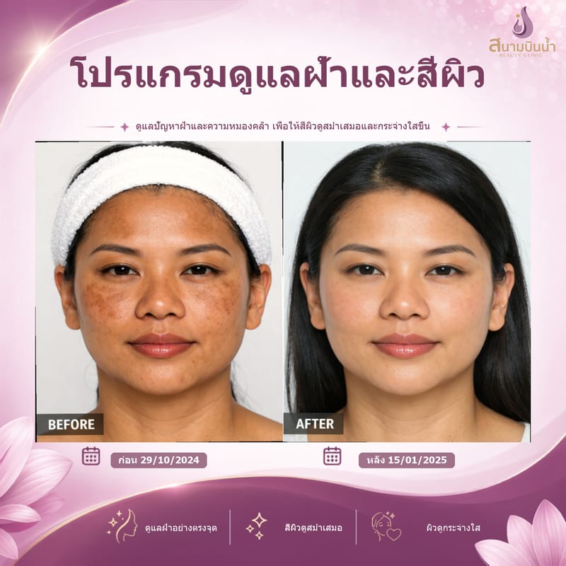 ภาพก่อน–หลัง รักษาฝ้า กรณีเฉพาะบุคคล