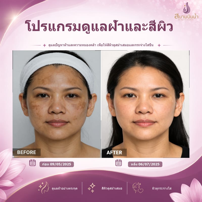 ภาพก่อน–หลัง รักษาฝ้า กรณีเฉพาะบุคคล
