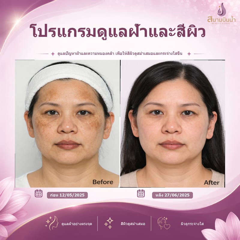 ภาพก่อน–หลัง รักษาฝ้า กรณีเฉพาะบุคคล