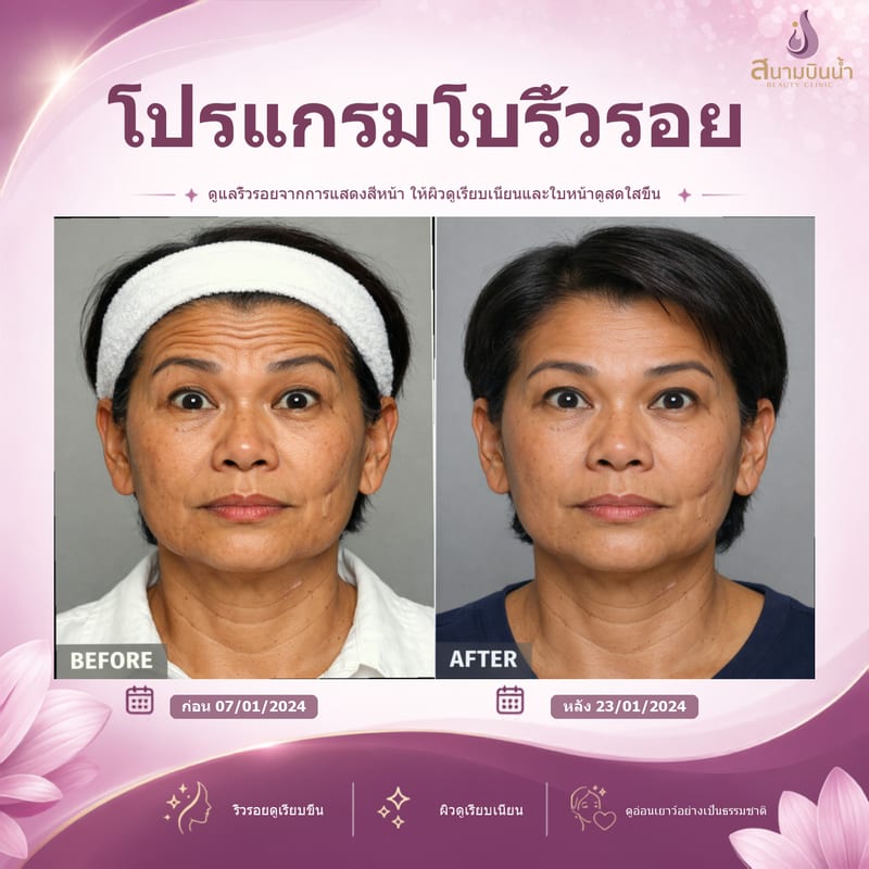 ภาพก่อน–หลัง โบท็อกซ์ริ้วรอย กรณีเฉพาะบุคคล