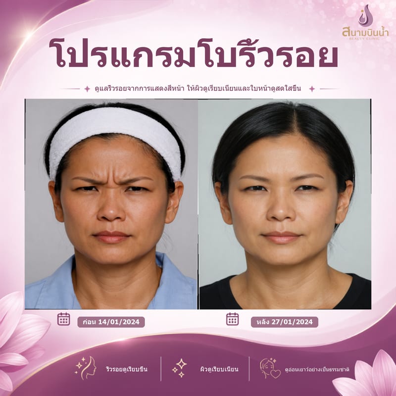 ภาพก่อน–หลัง โบท็อกซ์ริ้วรอย กรณีเฉพาะบุคคล