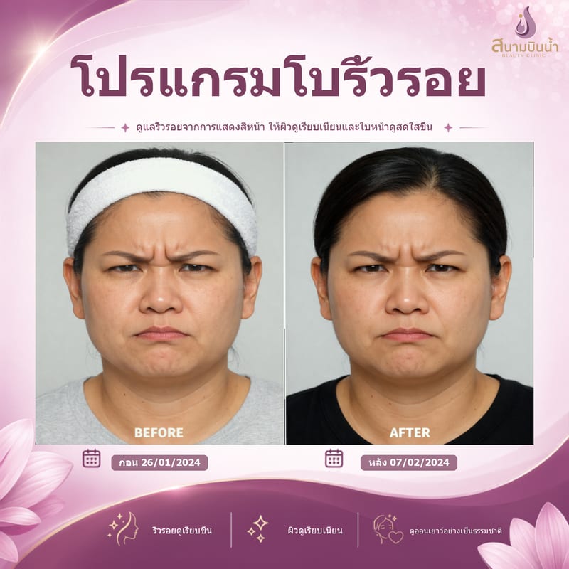 ภาพก่อน–หลัง โบท็อกซ์ริ้วรอย กรณีเฉพาะบุคคล