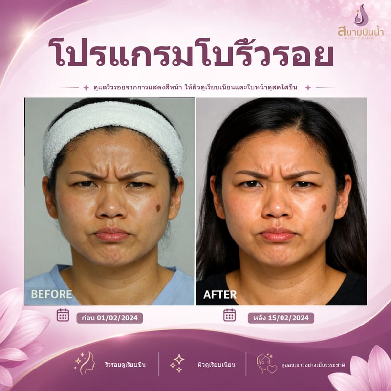 ภาพก่อน–หลัง โบท็อกซ์ริ้วรอย กรณีเฉพาะบุคคล