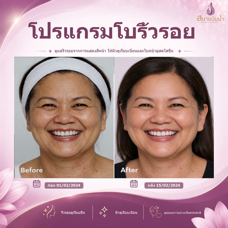 ภาพก่อน–หลัง โบท็อกซ์ริ้วรอย กรณีเฉพาะบุคคล