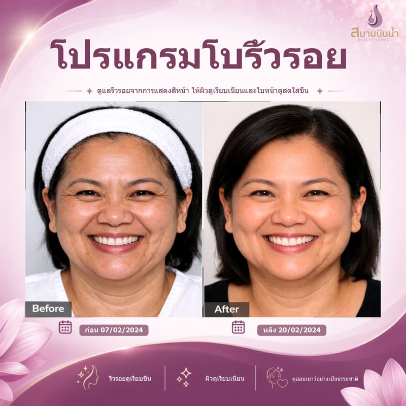 ภาพก่อน–หลัง โบท็อกซ์ริ้วรอย กรณีเฉพาะบุคคล