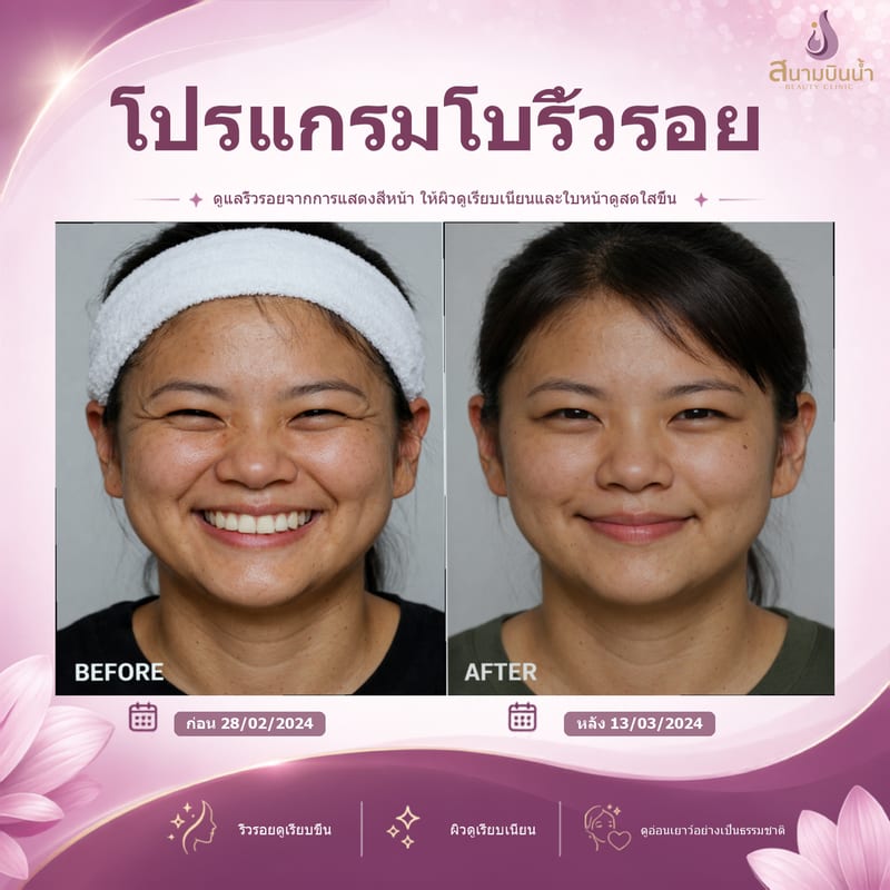 ภาพก่อน–หลัง โบท็อกซ์ริ้วรอย กรณีเฉพาะบุคคล
