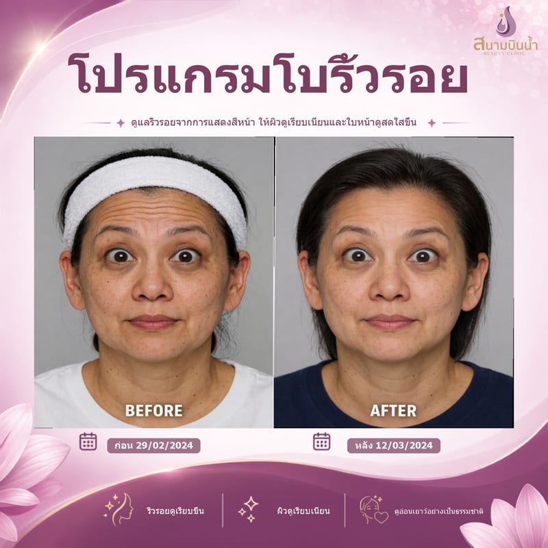 ภาพก่อน–หลัง โบท็อกซ์ริ้วรอย กรณีเฉพาะบุคคล