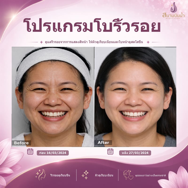 ภาพก่อน–หลัง โบท็อกซ์ริ้วรอย กรณีเฉพาะบุคคล