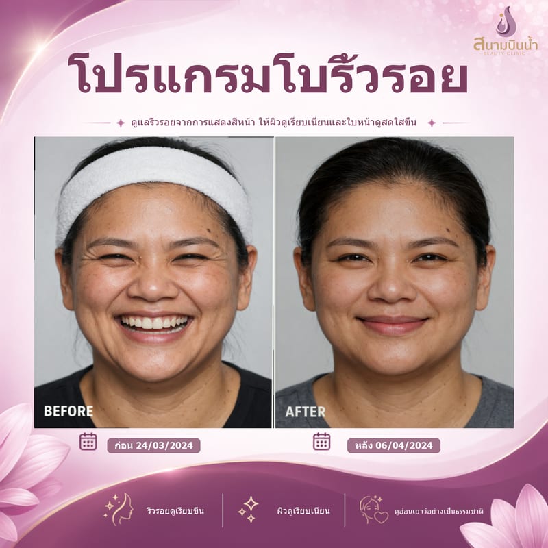 ภาพก่อน–หลัง โบท็อกซ์ริ้วรอย กรณีเฉพาะบุคคล