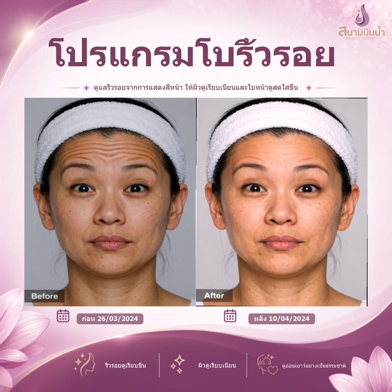 ภาพก่อน–หลัง โบท็อกซ์ริ้วรอย กรณีเฉพาะบุคคล