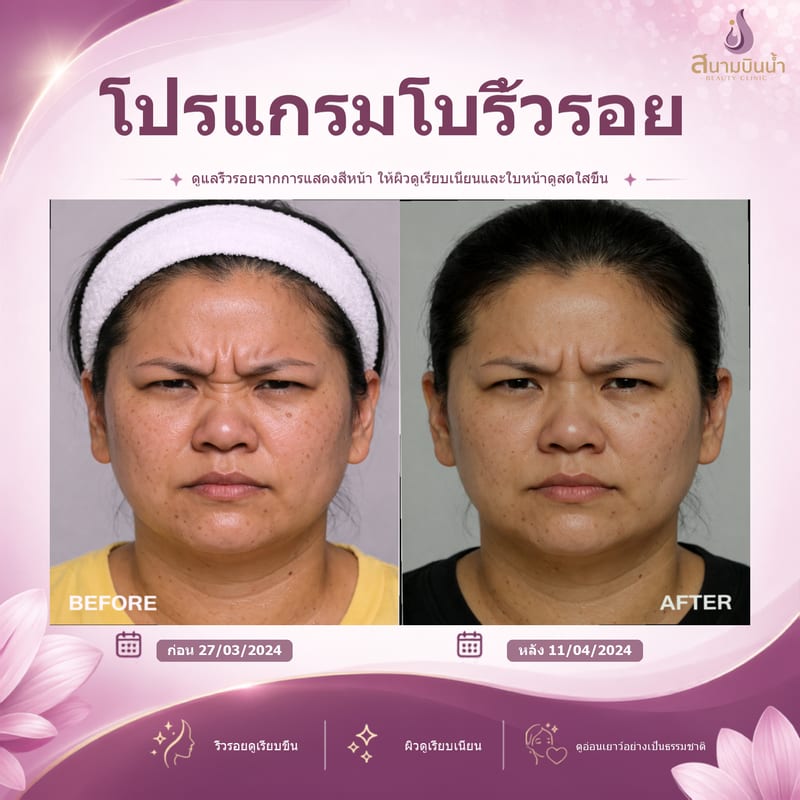 ภาพก่อน–หลัง โบท็อกซ์ริ้วรอย กรณีเฉพาะบุคคล