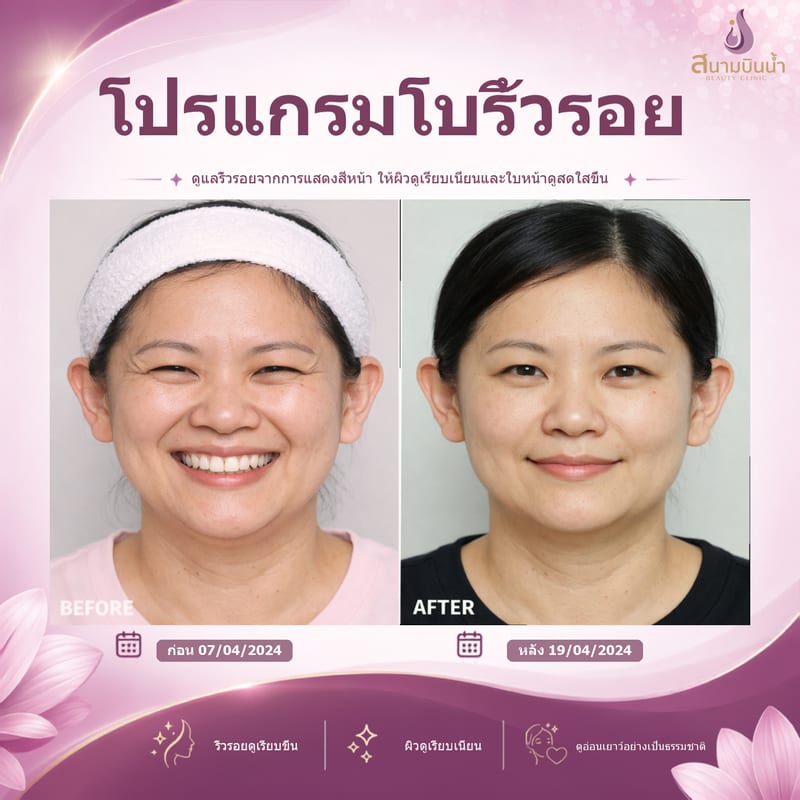 ภาพก่อน–หลัง โบท็อกซ์ริ้วรอย กรณีเฉพาะบุคคล