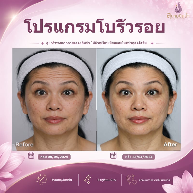 ภาพก่อน–หลัง โบท็อกซ์ริ้วรอย กรณีเฉพาะบุคคล