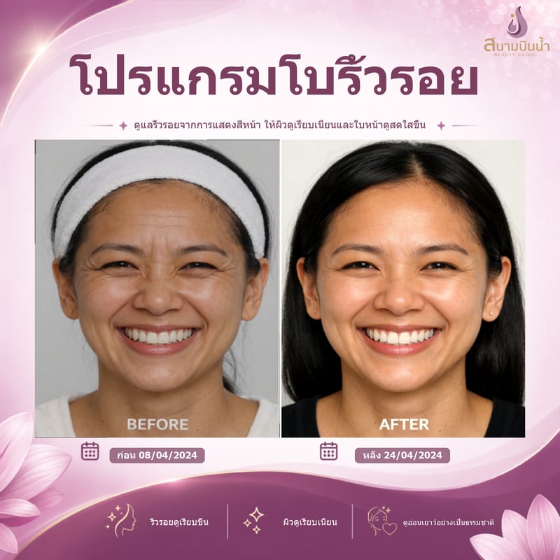 ภาพก่อน–หลัง โบท็อกซ์ริ้วรอย กรณีเฉพาะบุคคล
