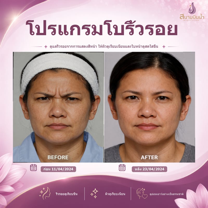 ภาพก่อน–หลัง โบท็อกซ์ริ้วรอย กรณีเฉพาะบุคคล