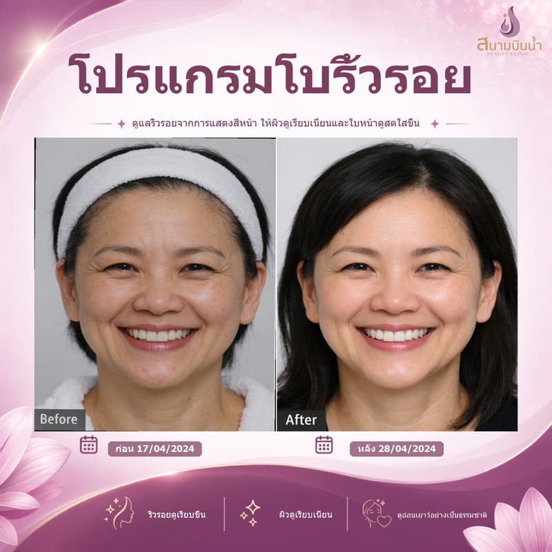 ภาพก่อน–หลัง โบท็อกซ์ริ้วรอย กรณีเฉพาะบุคคล