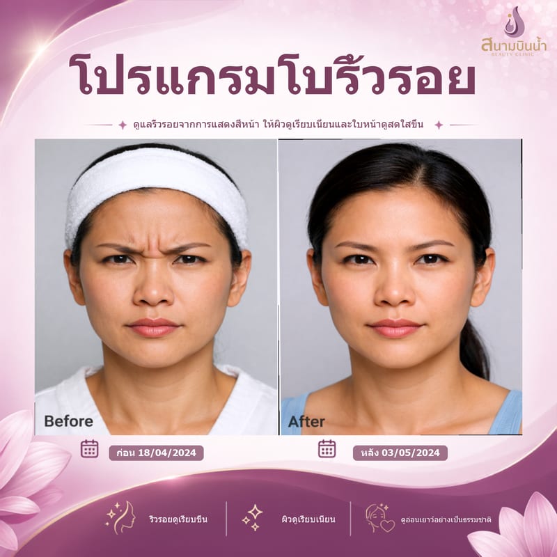 ภาพก่อน–หลัง โบท็อกซ์ริ้วรอย กรณีเฉพาะบุคคล