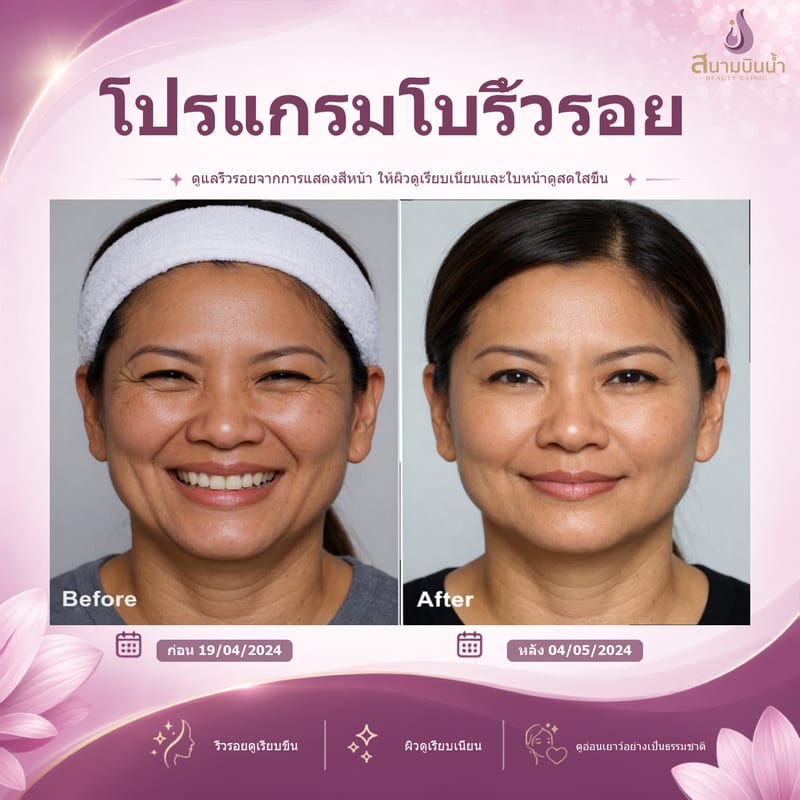 ภาพก่อน–หลัง โบท็อกซ์ริ้วรอย กรณีเฉพาะบุคคล