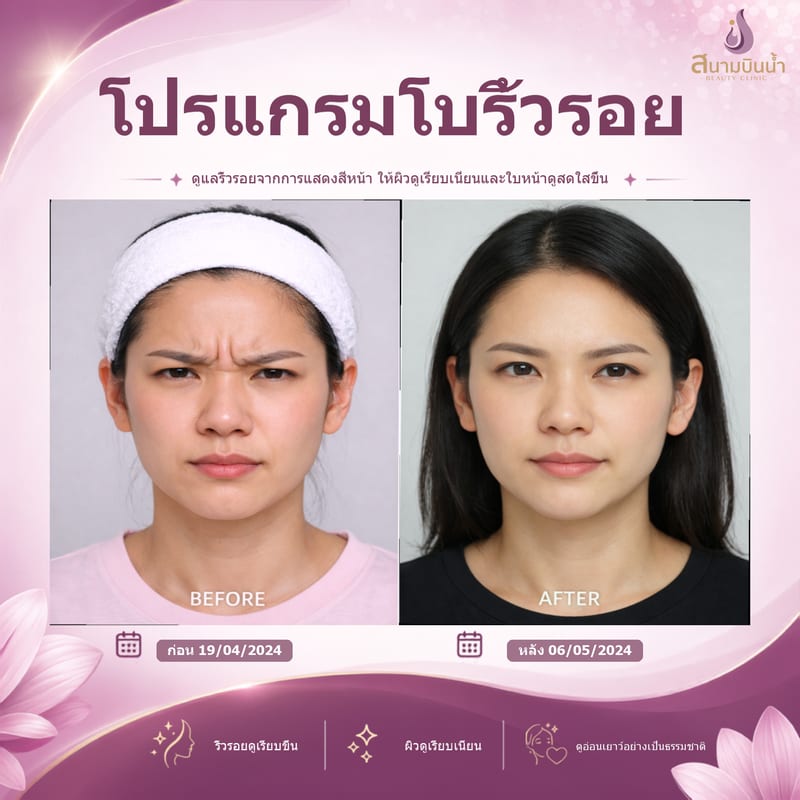 ภาพก่อน–หลัง โบท็อกซ์ริ้วรอย กรณีเฉพาะบุคคล