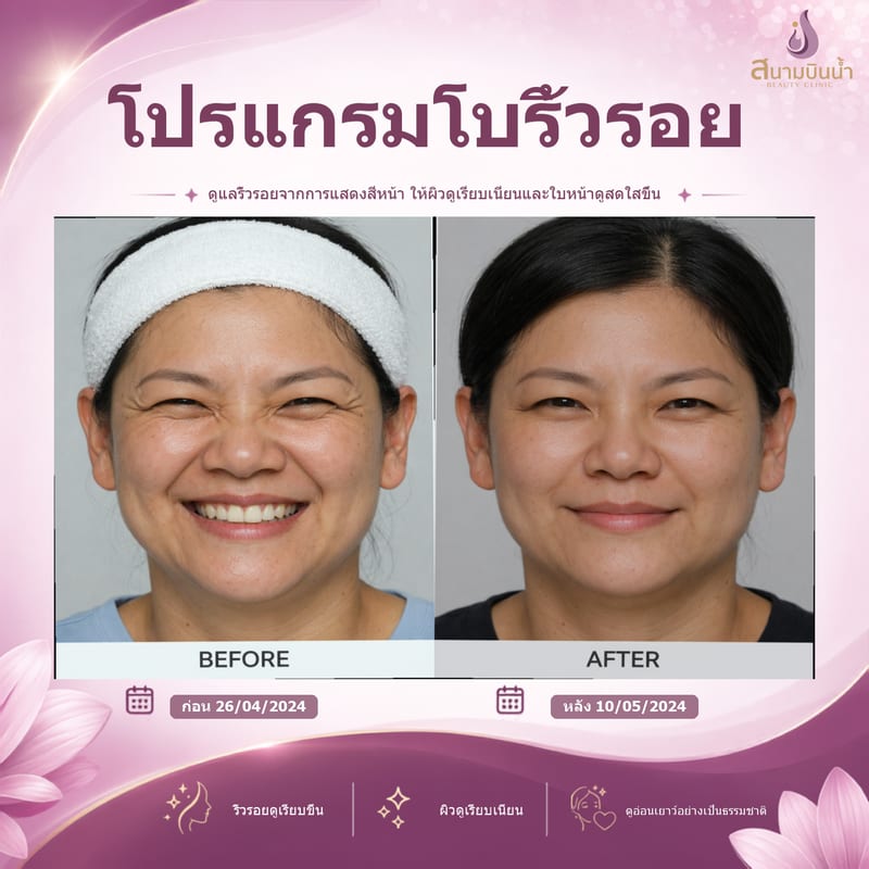 ภาพก่อน–หลัง โบท็อกซ์ริ้วรอย กรณีเฉพาะบุคคล