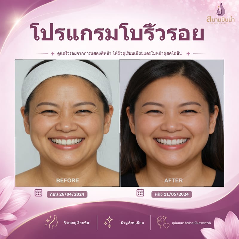ภาพก่อน–หลัง โบท็อกซ์ริ้วรอย กรณีเฉพาะบุคคล