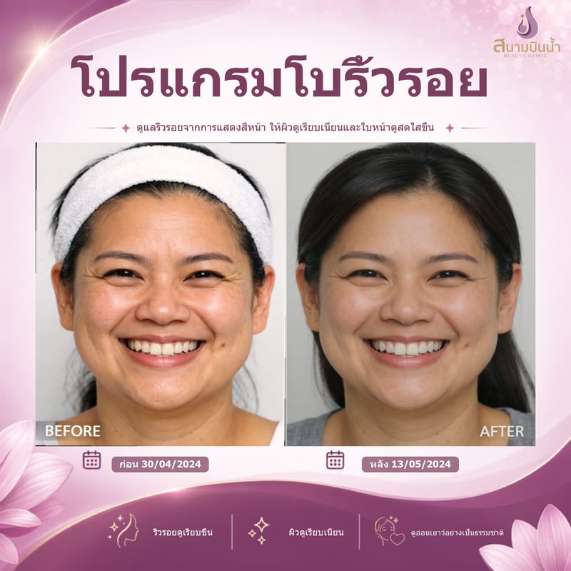 ภาพก่อน–หลัง โบท็อกซ์ริ้วรอย กรณีเฉพาะบุคคล