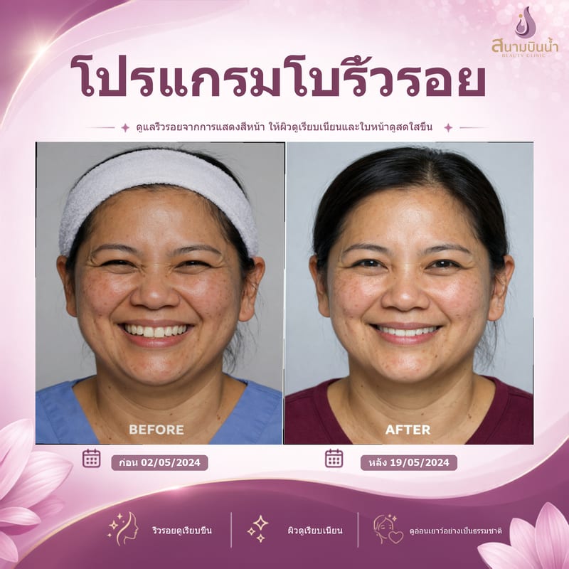ภาพก่อน–หลัง โบท็อกซ์ริ้วรอย กรณีเฉพาะบุคคล