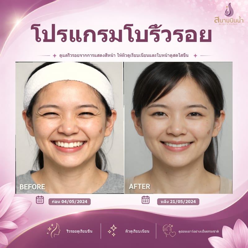 ภาพก่อน–หลัง โบท็อกซ์ริ้วรอย กรณีเฉพาะบุคคล