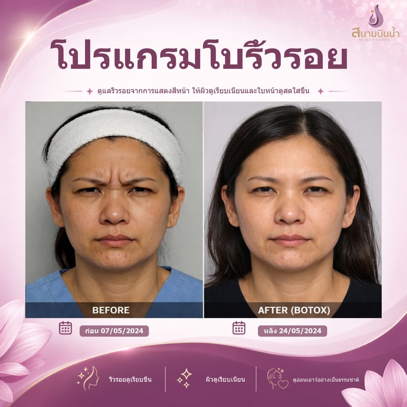 ภาพก่อน–หลัง โบท็อกซ์ริ้วรอย กรณีเฉพาะบุคคล