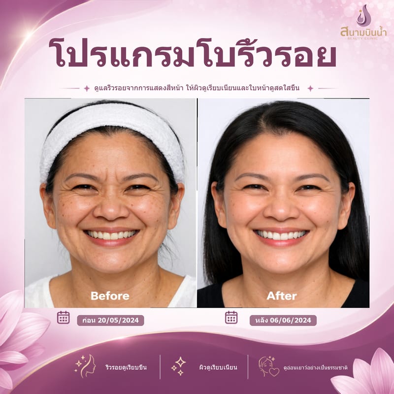 ภาพก่อน–หลัง โบท็อกซ์ริ้วรอย กรณีเฉพาะบุคคล