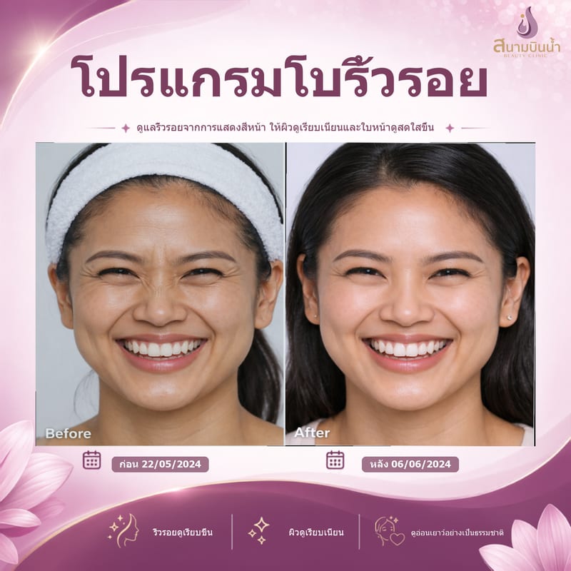 ภาพก่อน–หลัง โบท็อกซ์ริ้วรอย กรณีเฉพาะบุคคล