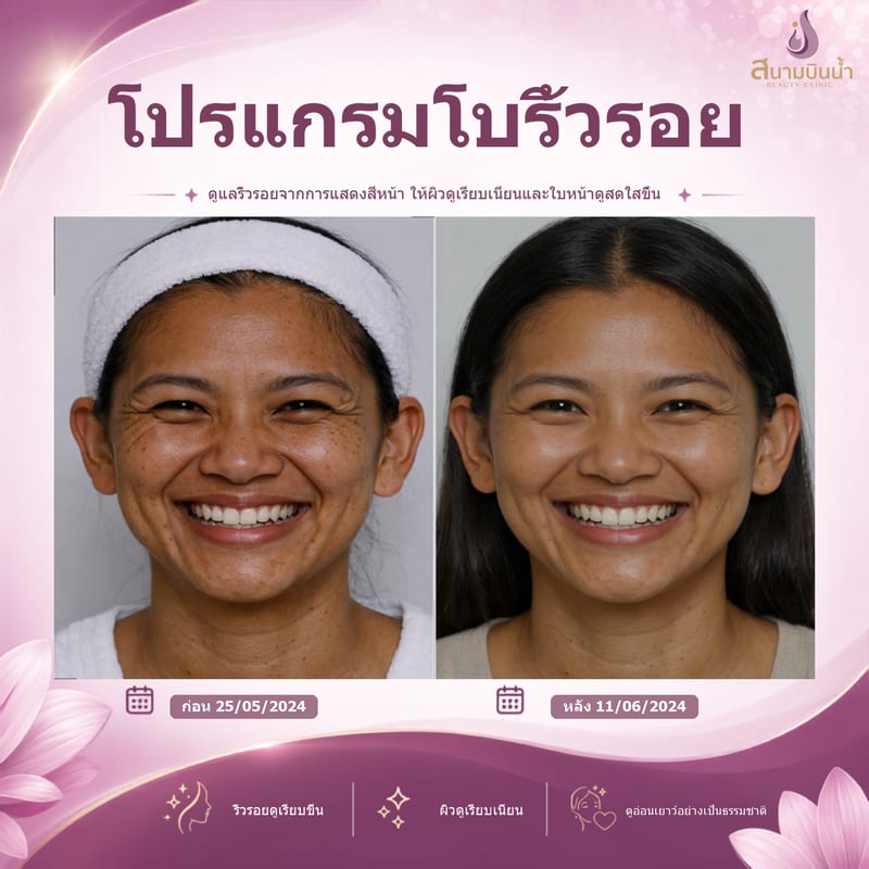 ภาพก่อน–หลัง โบท็อกซ์ริ้วรอย กรณีเฉพาะบุคคล
