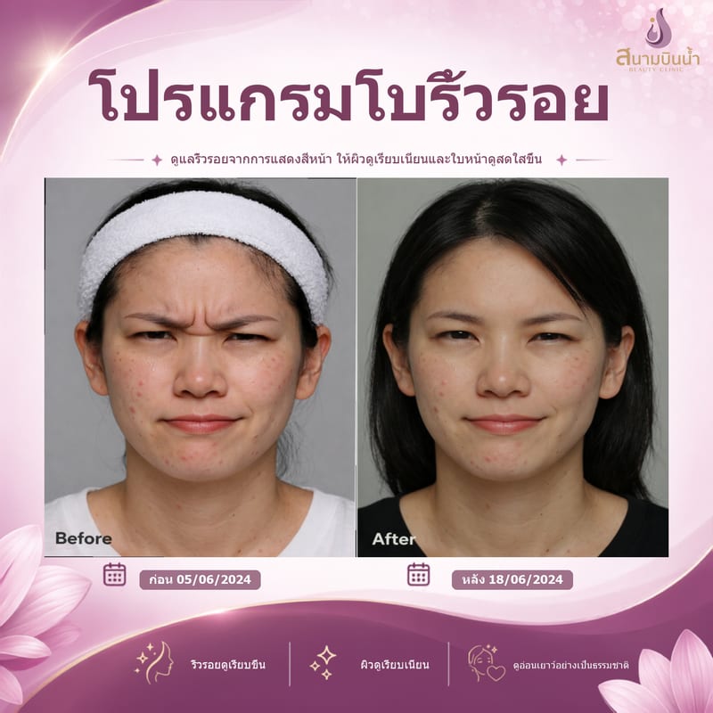 ภาพก่อน–หลัง โบท็อกซ์ริ้วรอย กรณีเฉพาะบุคคล