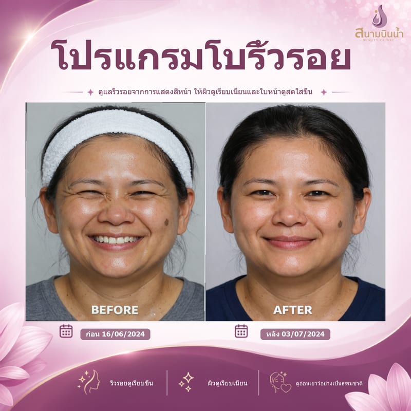 ภาพก่อน–หลัง โบท็อกซ์ริ้วรอย กรณีเฉพาะบุคคล