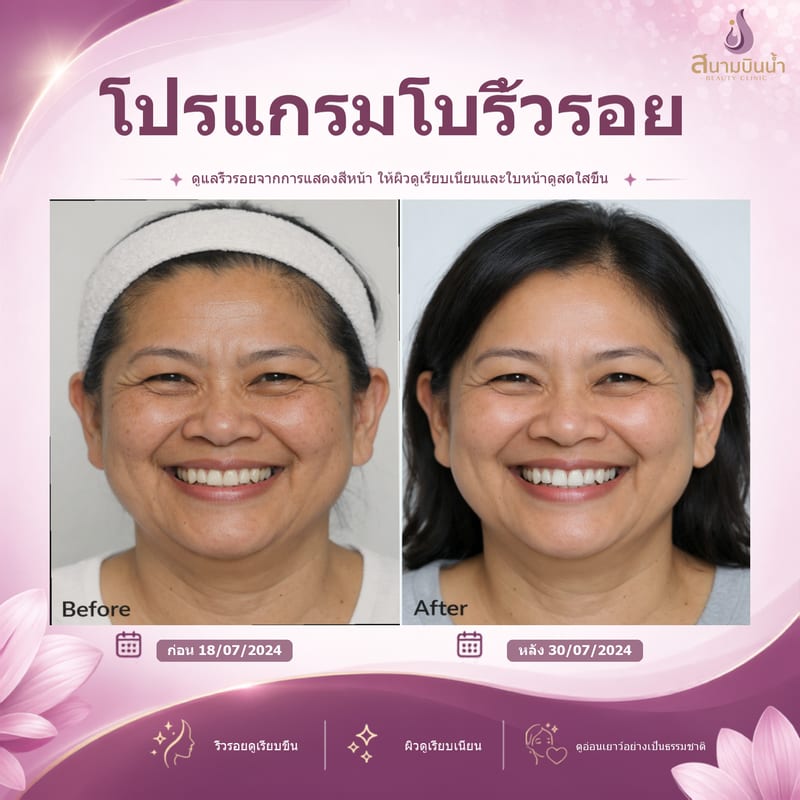 ภาพก่อน–หลัง โบท็อกซ์ริ้วรอย กรณีเฉพาะบุคคล