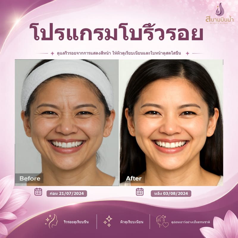 ภาพก่อน–หลัง โบท็อกซ์ริ้วรอย กรณีเฉพาะบุคคล