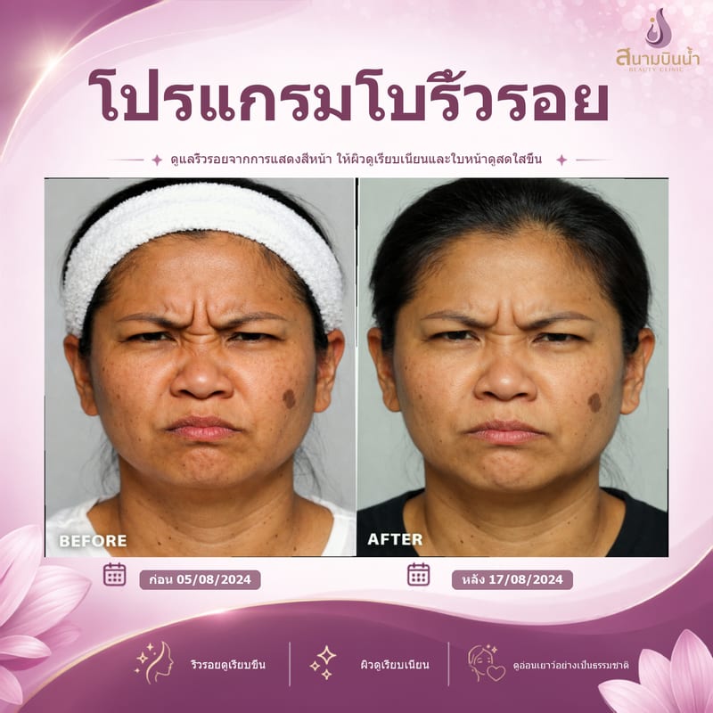 ภาพก่อน–หลัง โบท็อกซ์ริ้วรอย กรณีเฉพาะบุคคล