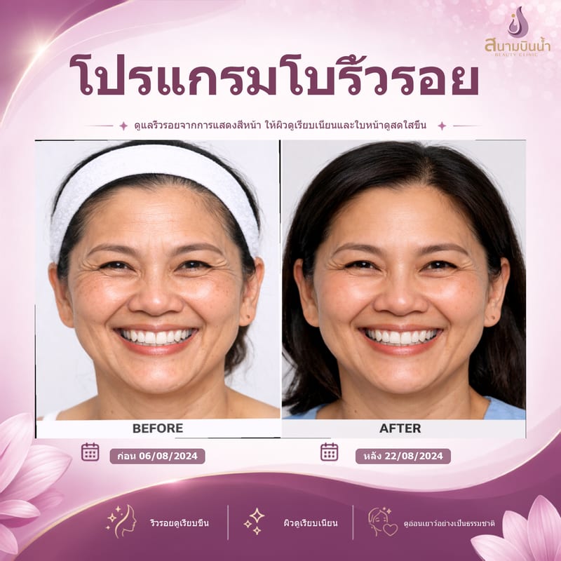 ภาพก่อน–หลัง โบท็อกซ์ริ้วรอย กรณีเฉพาะบุคคล
