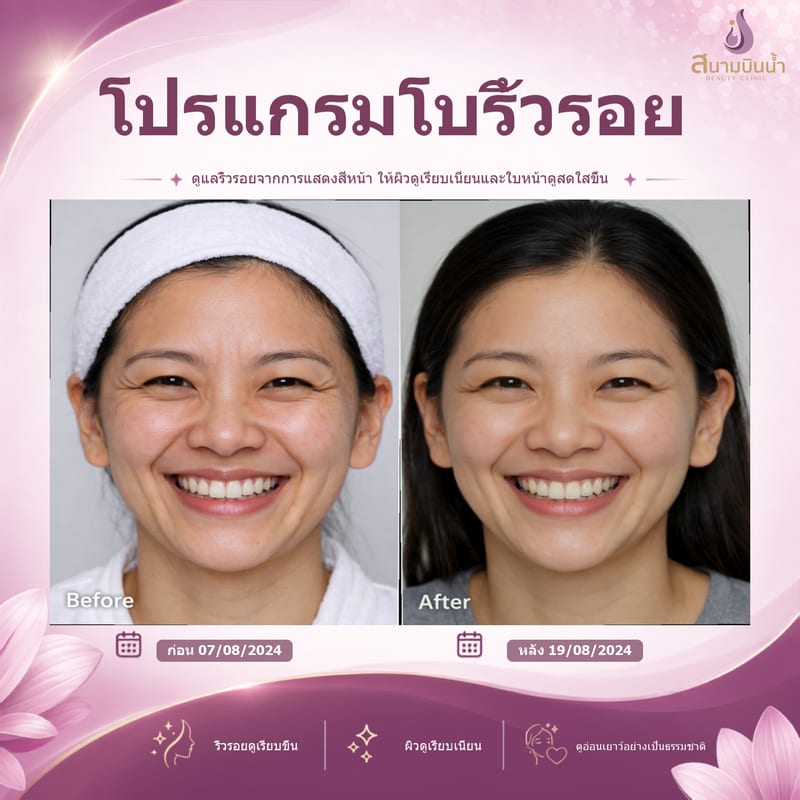 ภาพก่อน–หลัง โบท็อกซ์ริ้วรอย กรณีเฉพาะบุคคล