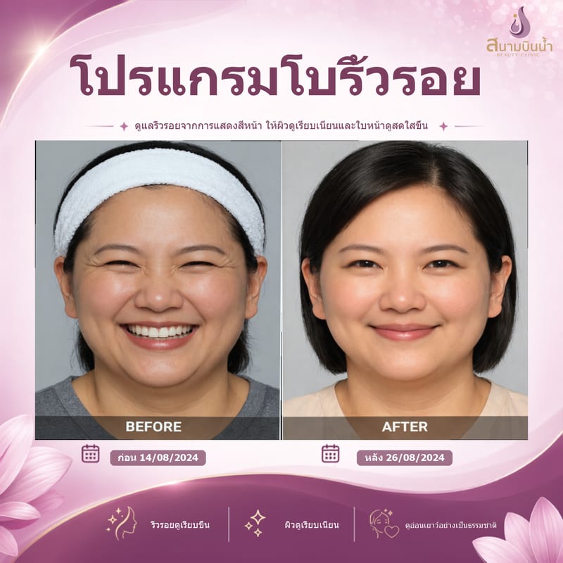 ภาพก่อน–หลัง โบท็อกซ์ริ้วรอย กรณีเฉพาะบุคคล