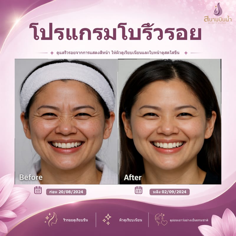 ภาพก่อน–หลัง โบท็อกซ์ริ้วรอย กรณีเฉพาะบุคคล