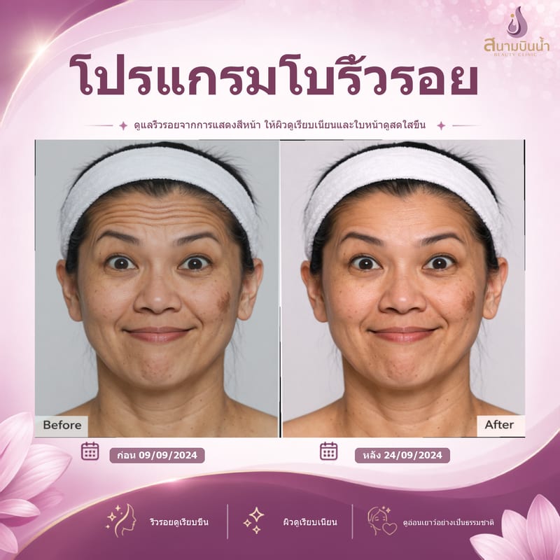 ภาพก่อน–หลัง โบท็อกซ์ริ้วรอย กรณีเฉพาะบุคคล