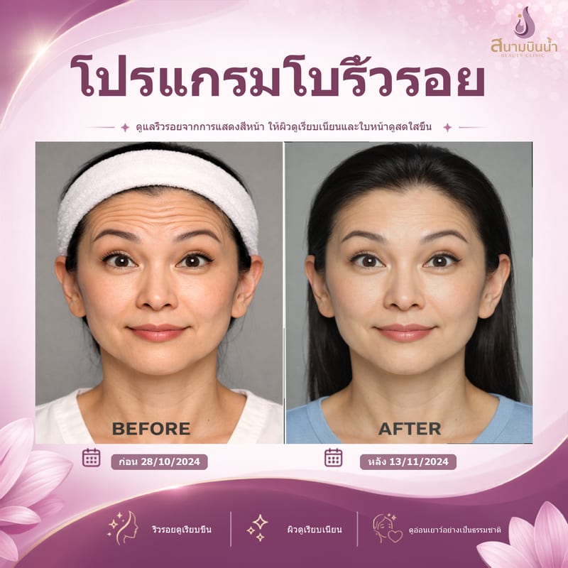ภาพก่อน–หลัง โบท็อกซ์ริ้วรอย กรณีเฉพาะบุคคล