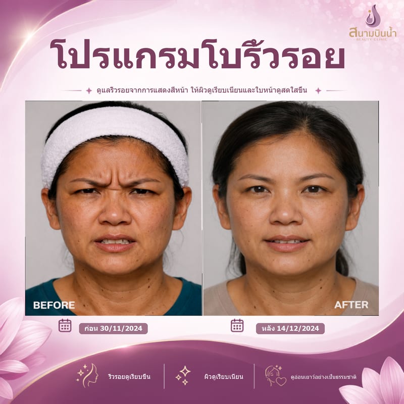 ภาพก่อน–หลัง โบท็อกซ์ริ้วรอย กรณีเฉพาะบุคคล